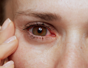 olho-seco-e-vermelhidao-ocular-730x340